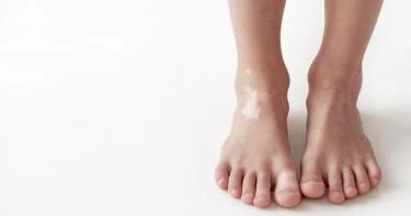 مرض البهاق عند الأطفال