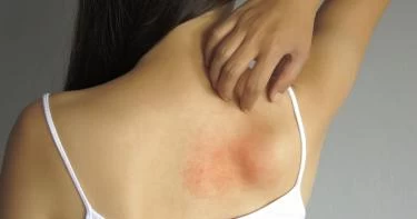 أسباب حساسية الجلد المفاجئة