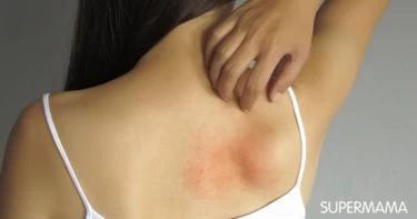 أسباب حساسية الجلد المفاجئة