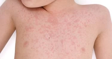 أعراض نقص الصفائح الدموية عند الأطفال