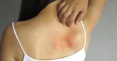 هل إصابتك بالحزام الناري تسبب الوفاة؟