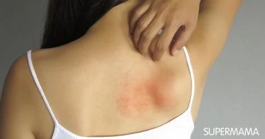 هل إصابتك بالحزام الناري تسبب الوفاة؟