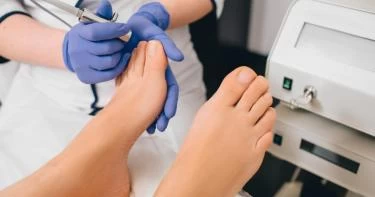 علاج فطريات الأظافر بالليزر