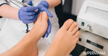 علاج فطريات الأظافر بالليزر