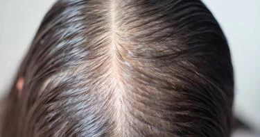 زراعة الشعر للنساء