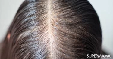 زراعة الشعر للنساء