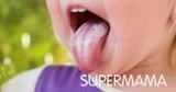 أسباب فطريات اللسان عند الأطفال وعلاجها