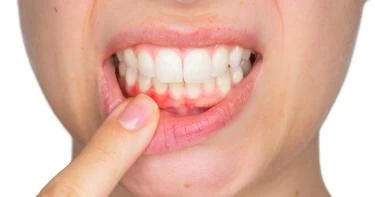 علاج اللثة الملتهبة