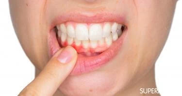 علاج اللثة الملتهبة