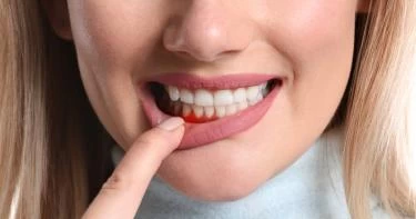 علاج نزيف اللثة