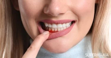 علاج نزيف اللثة