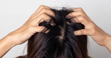 حساسية فروة الرأس