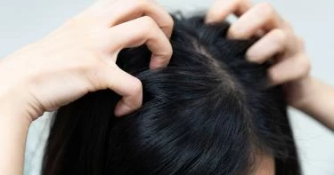 أسباب حكة فروة الرأس