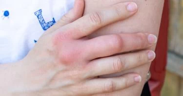 أعراض تورم الأصابع