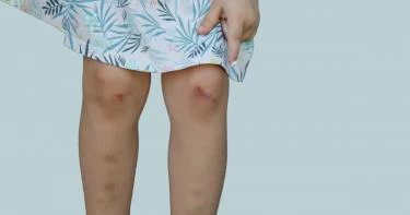 أسباب الكدمات عند الأطفال