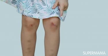 أسباب الكدمات عند الأطفال