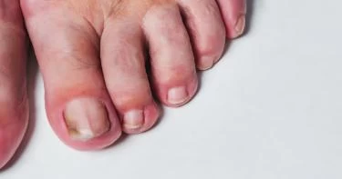 أسباب ظهور الظفر الأسود