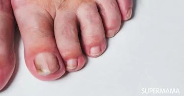 أسباب ظهور الظفر الأسود