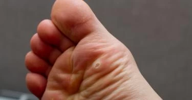 الفرق بين عين السمكة ومسمار القدم