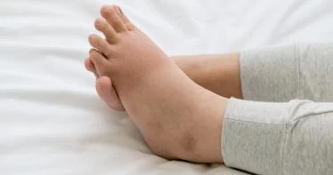 أسباب تورم الكاحلين