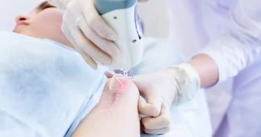 إزالة آثار الجروح بالليزر