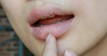 أسباب ابيضاض الشفاه