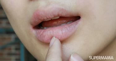 أسباب ابيضاض الشفاه