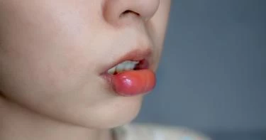علاج تورم الشفايف