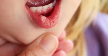 أسباب تقرحات الفم عند الأطفال