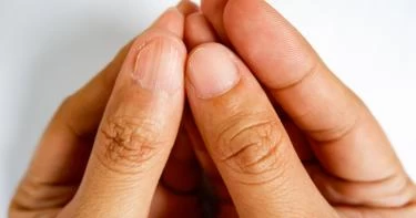 علاج الأظافر المتعرجة