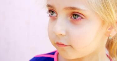 أسباب حساسية العيون عند الأطفال