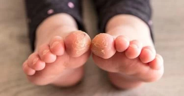أسباب تشققات الجلد عند الأطفال