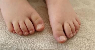 فطريات الأظافر عند الأطفال