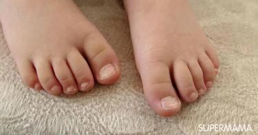 فطريات الأظافر عند الأطفال