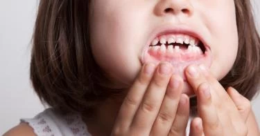 علاج الأسنان المتآكلة عند الأطفال