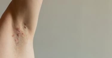 أسباب ظهور حبوب تحت الإبط