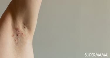 أسباب ظهور حبوب تحت الإبط
