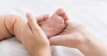 أعراض مرض pku عند الرضع