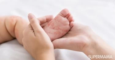 أعراض مرض pku عند الرضع