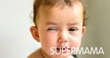 ما أعراض ضمور العصب البصري عند الرضع؟