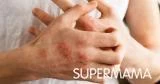 هل يمكن علاج الإكزيما بالعسل؟