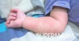 ما أسباب الإكزيما عند الرضع؟