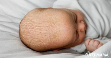 الأكزيما الدهنية عند الرضع