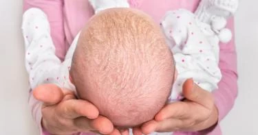 أعراض الصدفية عند الرضع