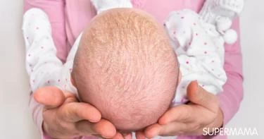 أعراض الصدفية عند الرضع