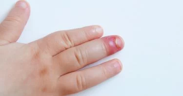 علاج الإصبع المدوحس عند الأطفال