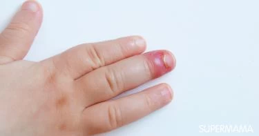 علاج الإصبع المدوحس عند الأطفال