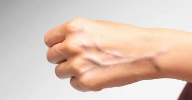 أسباب بروزعروق اليدين