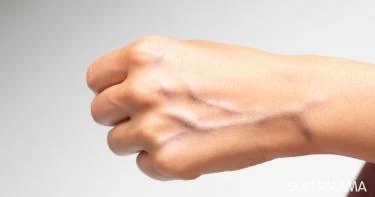 أسباب بروزعروق اليدين