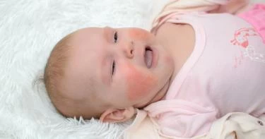 أعراض حساسية البيض عند الرضع وأهم أسبابها